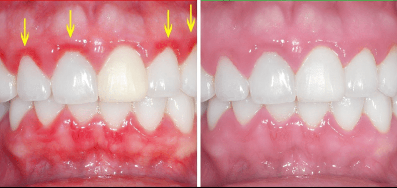 Read more about the article GINGIVITIS